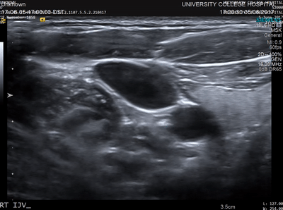 Diagnostic ultrasound image of the internal jugular vein.